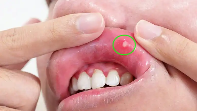 Vücut İçin Hayati Önemi Olan 5 Belirgin B Vitamini Eksikliği Belirtisi