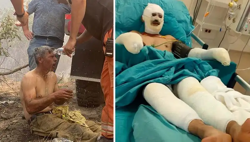 Orman İşçisinin "Yanıyorum" Feryadı: Tedavi Süreci Devam Ediyor
