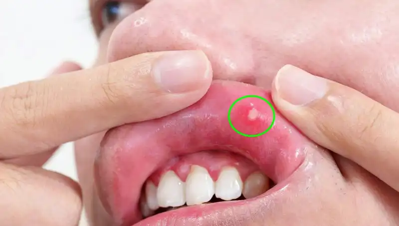 Kanser Belirtilerini Göz Ardı Eden Adamın Şaşırtan Hikayesi